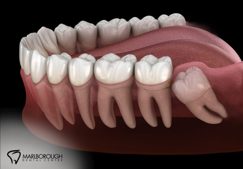 Navigating Complications and Pain Management Post-Wisdom Teeth Removal